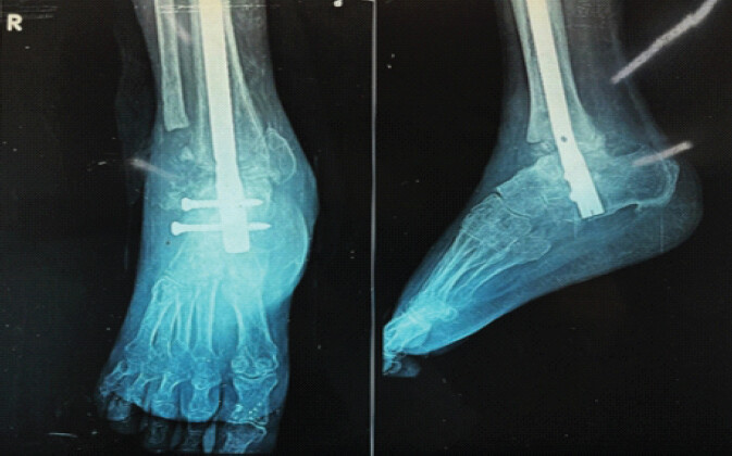 Figure 3: Anteroposterior and lateral radiographs of the right ankle demonstrating failed tibiotalocalcaneal arthrodesis with an intramedullary hindfoot nail in situ and absence of fusion at the ankle and subtalar joints.