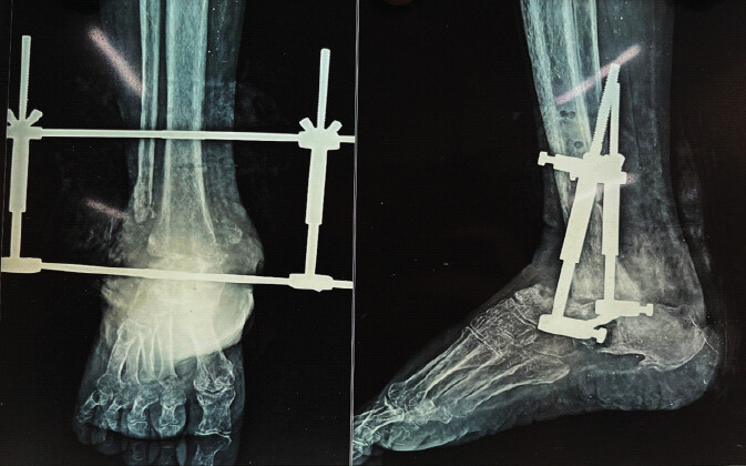 Figure 4: Anteroposterior and lateral radiographs of the right ankle showing Charnley compression arthrodesis with external fixator in situ and absence of radiological fusion at the ankle joint.