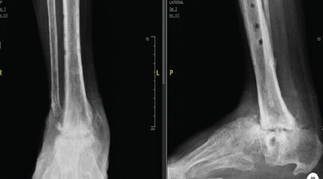 Figure 5: Anteroposterior and lateral radiographs of the right ankle at presentation to our center demonstrating persistent ankle non-union with deformity following failed prior fixation and arthrodesis procedures.