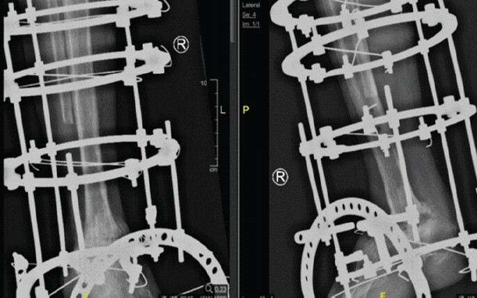 Figure 6: Immediate post-operative anteroposterior and lateral radiographs of the right ankle showing definitive arthrodesis using Ilizarov circular external fixation with application of controlled compression across the ankle joint.