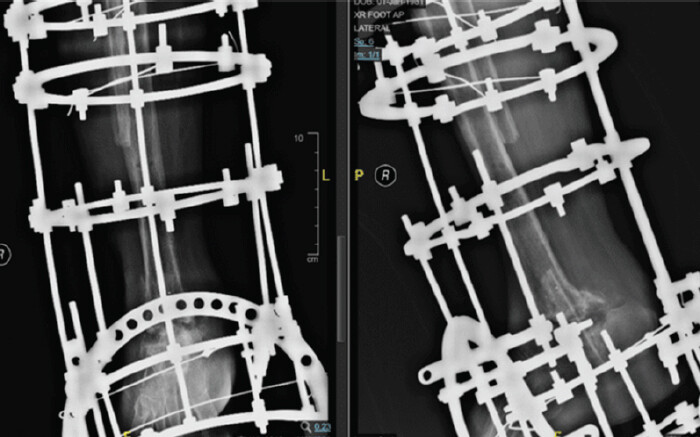 Figure 7: Follow-up anteroposterior and lateral radiographs of the right ankle demonstrating progressive consolidation at the arthrodesis site with Ilizarov circular external fixation in situ.