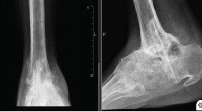 Figure 8: Anteroposterior and lateral radiographs of the right ankle at 1-year follow-up after removal of the Ilizarov frame, demonstrating solid arthrodesis with maintained alignment.