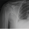 Atypical Idiopathic Inferior Functional Shoulder Instability in a 15-year-old Female: A Case Report and Review of Literature
