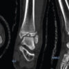Hardware-Associated Superficial Peroneal Nerve Entrapment Following Syndesmotic Stabilization: A Case Report