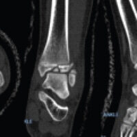 Figure 1: Initial computed tomography scan of the left ankle. Axial (left), coronal (center), and sagittal (right) images demonstrate a triplane fracture of the distal tibia with intra-articular displacement.