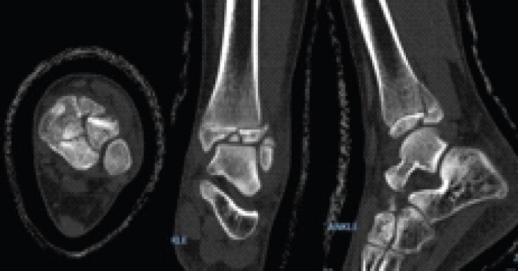 Figure 1: Initial computed tomography scan of the left ankle. Axial (left), coronal (center), and sagittal (right) images demonstrate a triplane fracture of the distal tibia with intra-articular displacement.