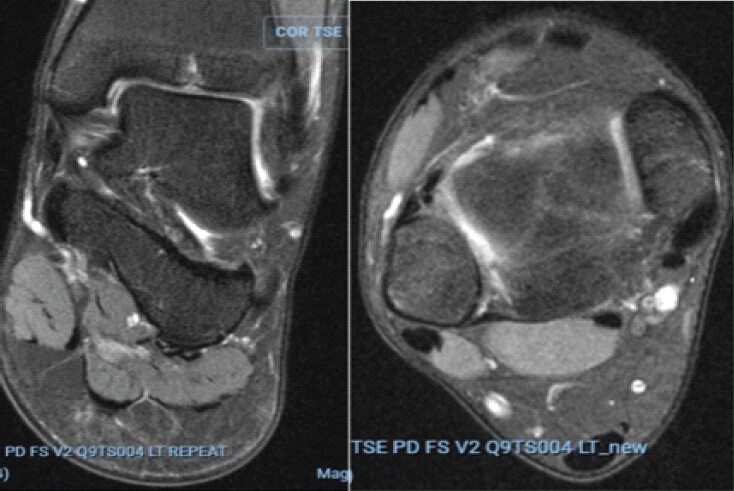 Figure 2: Magnetic resonance imaging of the left ankle obtained for persistent pain following triplane fracture healing. Coronal (left) and axial (right) images demonstrate residual linear signal abnormality in the distal tibial epiphysis, focal chondral irregularity, and signal abnormalities involving the anterior inferior tibiofibular ligament and anterior talofibular ligament.