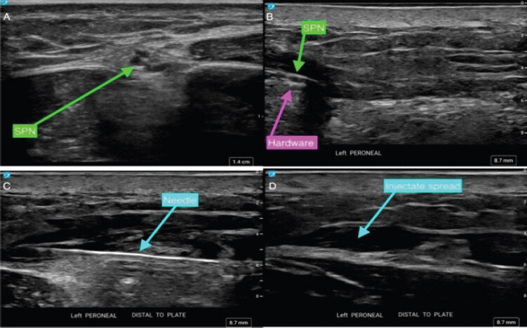 Figure 3: Ultrasound evaluation of the superficial peroneal nerve (SPN) in the setting of suspected SPN entrapment. (a) Ultrasound image demonstrating identification of the SPN with preservation of normal fascicular architecture. (b) Localization of the SPN in the region of syndesmotic fixation. (c) Ultrasound-guided diagnostic injection and hydrodissection. (d) Post-procedural image following hydrodissection demonstrating spread of injectate surrounding the nerve. Despite limited visualization caused by metallic artifact, ultrasound facilitated nerve localization and guided diagnostic intervention.