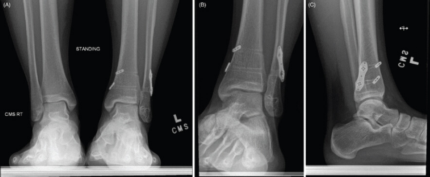 Figure 4: Pre-operative radiographs obtained before superficial peroneal nerve (SPN) exploration and hardware removal. (a) Bilateral standing anteroposterior ankle radiographs demonstrating maintained syndesmotic reduction. (b) Left ankle mortise radiograph demonstrating the retained lateral fibular plate and dual suture-button syndesmotic fixation construct. (c) Left ankle lateral radiograph demonstrating maintained alignment of the ankle mortise and retained syndesmotic fixation construct.