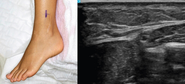 Figure 5: Pre-operative localization of the superficial peroneal nerve (SPN). Clinical skin marking (left) and corresponding ultrasound image (right) were used to identify the projected course of the SPN relative to the syndesmotic hardware before surgical exploration. The longitudinal scar represents the previous lateral surgical approach for syndesmotic stabilization and is separate from the ultrasound skin marking.