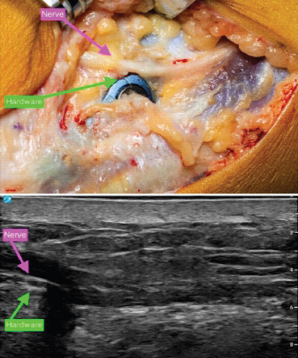 Figure 6: Correlation between pre-operative ultrasound and intraoperative findings. Ultrasound (bottom) demonstrates the superficial peroneal nerve (SPN) immediately adjacent to the syndesmotic hardware. Surgical exploration (top) confirmed close proximity of the SPN to the hardware, supporting the diagnosis of hardware-associated nerve entrapment.