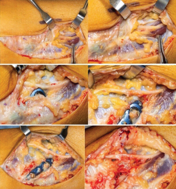 Figure 7: Intraoperative photographs demonstrating the superficial peroneal nerve (SPN) in close proximity to the syndesmotic hardware. Sequential images show identification of the nerve, neurolysis and decompression at the level of the implant, exposure of the suture-button fixation device, and hardware removal. The SPN remained structurally intact throughout its course.