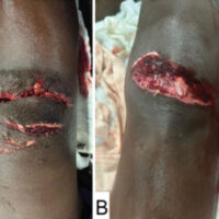 Figure 1: Clinical photographs of the open anterior knee injuries showing exposed soft tissue and contamination: right knee (a) and left knee (b).