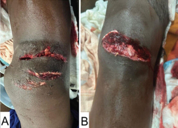 Figure 1: Clinical photographs of the open anterior knee injuries showing exposed soft tissue and contamination: right knee (a) and left knee (b).
