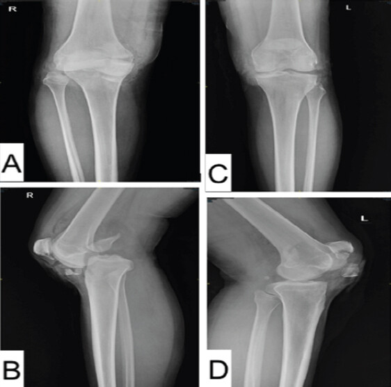 Figure 2: Pre-operative anteroposterior and lateral radiographs of the right knee (a and b) and left knee (c and d) showing bilateral medial Hoffa fractures and patellar fractures, with posterior dislocation of the right knee.