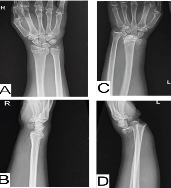 Figure 3: Pre-operative wrist radiographs: anteroposterior and lateral views of the right wrist (a and b) and left wrist (c and d), showing bilateral intra-articular distal radius fractures.
