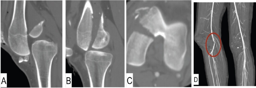 Figure 4: Computed tomography images of both knees and computed tomography angiography of the right lower limb. (A) Sagittal CT image of the right knee showing the medial Hoffa fracture. (B) Sagittal CT image of the left knee showing the medial Hoffa fracture. (C) Axial CT image of the left knee demonstrating the coronal fracture configuration of the medial femoral condyle. (D) CT angiogram showing focal compression and severe stenosis of the right mid-popliteal artery at the level of the posteriorly dislocated knee.