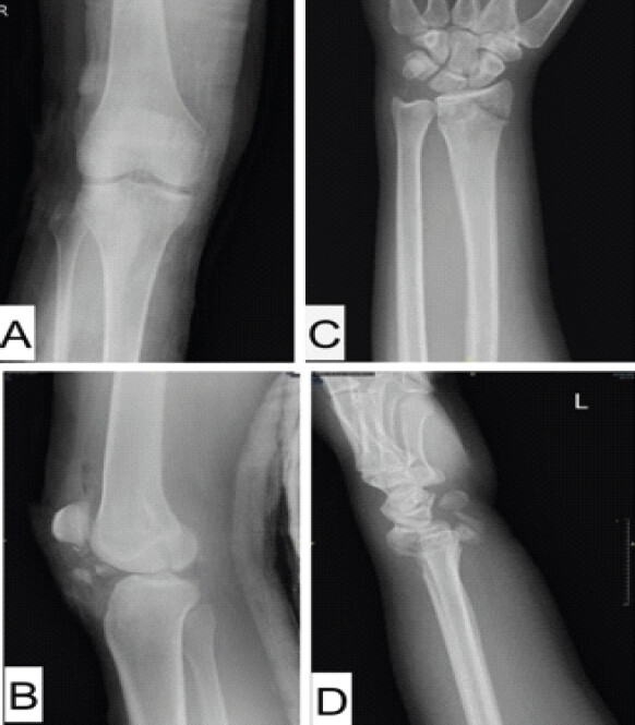 Figure 5: Post-reduction radiographs: anteroposterior and lateral views of the right knee (a and b) and left wrist (c and d).