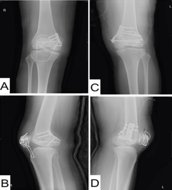 Figure 6: Immediate post-operative anteroposterior and lateral radiographs of the right knee and left knee after fixation of the bilateral medial Hoffa and patellar fractures.