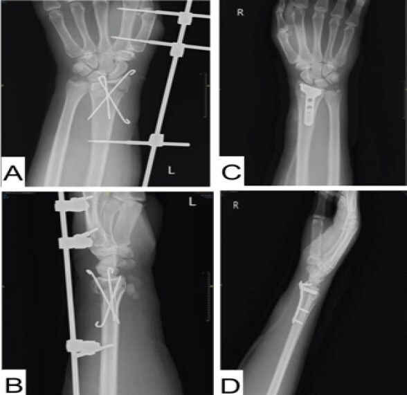 Figure 7: Immediate post-operative wrist radiographs: Kirschner-wire fixation with a wrist-spanning external fixator on the left wrist (a and b) and volar plate fixation of the right distal radius fracture (c and d).