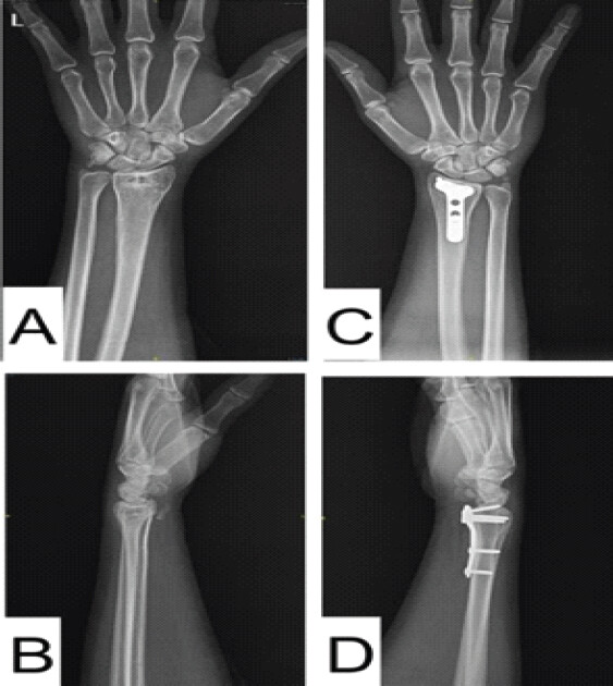 Figure 9: One-year anteroposterior radiographs of the left wrist (a and b) and right wrist (c and d) showing fracture union and satisfactory alignment.