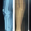 Posterior Cruciate Ligament Avulsion Fracture with Fibular Avulsion of Lateral Collateral Ligament-biceps Femoris Complex Avulsion Injury in Ipsilateral Diaphyseal Tibia Fracture – A Rare Complex Injury