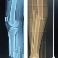 Figure 1: X-ray of knee and leg showing posterior cruciate ligament avulsion fracture with minimal comminution with displaced mid-shaft both-bone leg fracture.