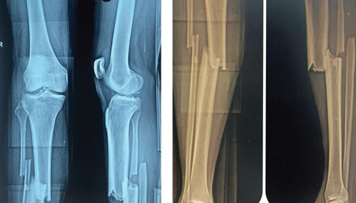 Figure 1: X-ray of knee and leg showing posterior cruciate ligament avulsion fracture with minimal comminution with displaced mid-shaft both-bone leg fracture.