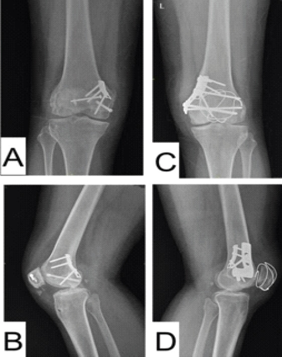 Figure 10: One-year anteroposterior and lateral radiographs of the right knee (a and b) and left knee (c and d) demonstrating fracture union and stable fixation.
