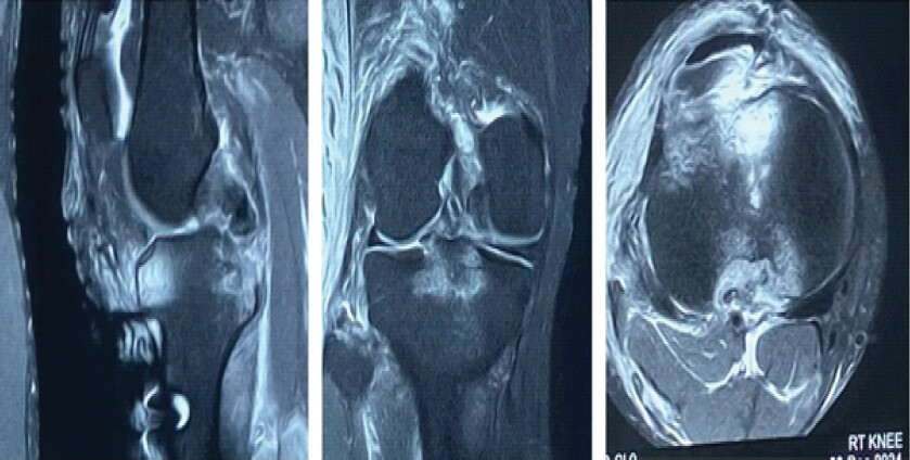 Figure 2: (a) Magnetic resonance imaging of right knee showing posterior cruciate ligament avulsion fracture with comminution with lateral collateral ligament and biceps femoris avulsion at fibular head.