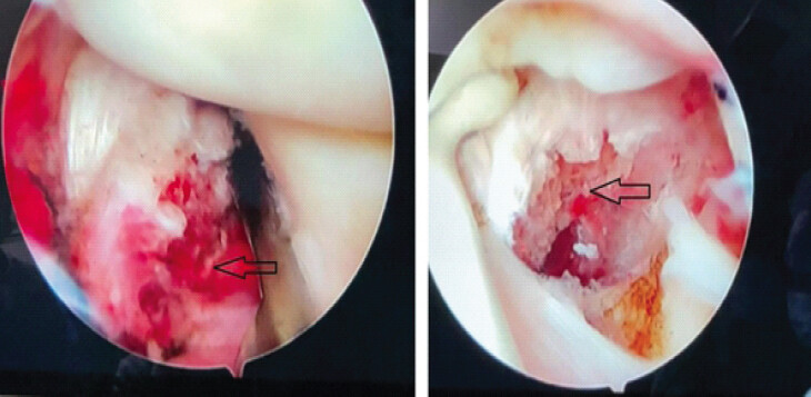 Figure3: Intraoperative arthroscopic pictures showing a displaced posterior cruciate ligament avulsed fragment.