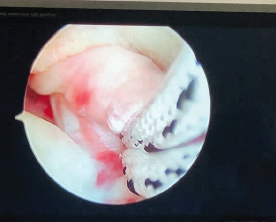 Figure 4: Intraoperative arthroscopic pictures showing placement of No. 2 fiberwires at posterior cruciate ligament – bone junction through high PM portal.
