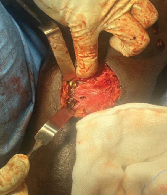 Figure 5: Intraoperative picture showing securing No 2 fibre wire to the proximal locking screws of tibial nail.