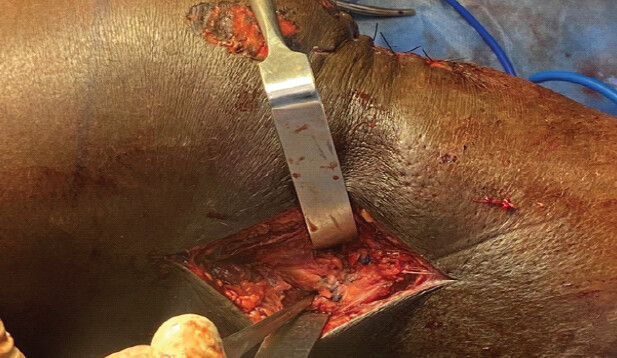 Figure 6: Intraoperative picture showing fixation of lateral collateral ligament-biceps femoris complex with 2 titanium suture anchors placed on fibular head.
