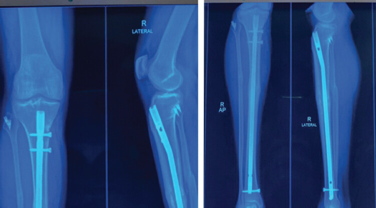 Figure 8: Clinical images of functional outcome at 18 months postoperatively.