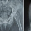 Positioning and Traction Application Technique in Patient with Below Knee Amputation Using the Patients Own Prosthesis for Intertrochanteric Femur Fracture Fixation Surgery: A Case Report with Review of Literature