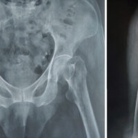 Figure 1: Pre-operative anteroposterior radiograph of the right hip showing an intertrochanteric femur fracture with impaction and varus angulation.