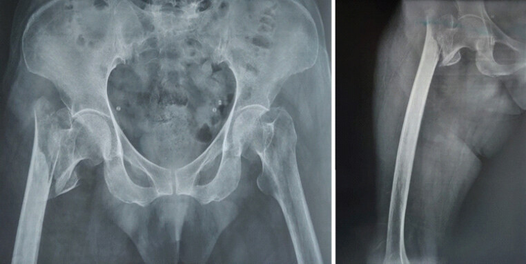 Figure 1: Pre-operative anteroposterior radiograph of the right hip showing an intertrochanteric femur fracture with impaction and varus angulation.