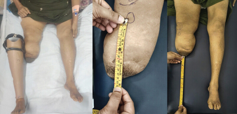 Figure 2: Photos of the patient’s own below-knee prosthesis along with the shortened limb.