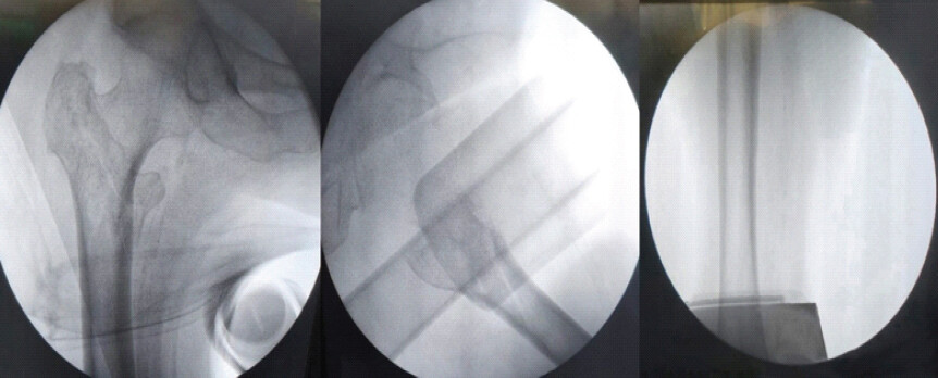 Figure 4: Intraoperative image intensifier view showing fracture alignment after application of traction.