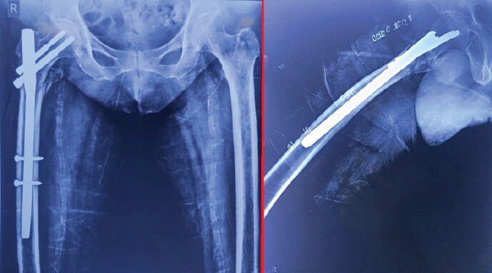 Figure 5: Immediate post-operative radiograph showing good alignment and stable fixation with the proximal femoral nail.