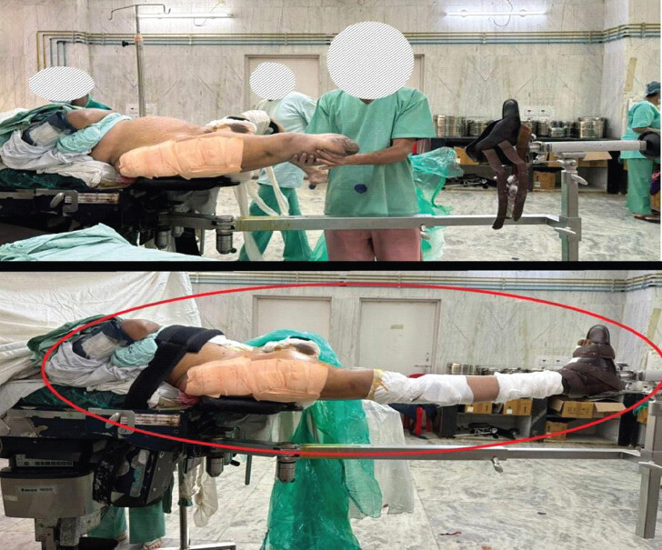 Figure 6: The prosthesis applied to the stump and fastened with an elastic adhesive bandage and Velcro straps, with the assembly mounted on the foot attachment of the fracture table.
