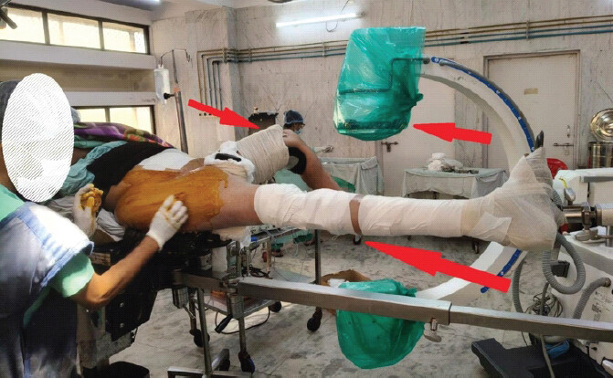 Figure 7: Positioning of the contralateral limb on the opposite attachment with the hip flexed to 90° and abducted to permit unobstructed image intensifier views.