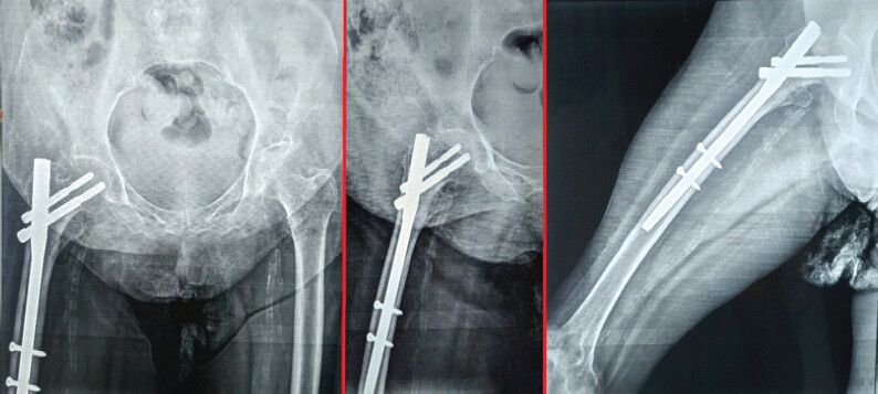Figure 8: Six-month post-operative radiograph showing good alignment and fracture union with the proximal femoral nail.
