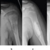 Telangiectatic Osteosarcoma Arising in a Treated Unicameral Bone Cyst of the Proximal Humerus: A Case Report