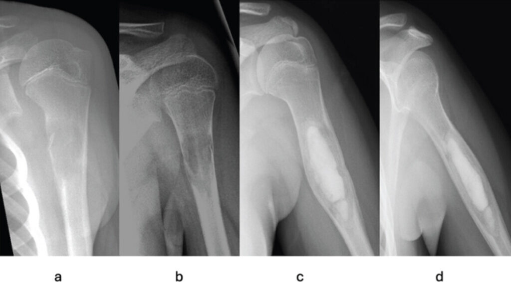 Figure 1: Initial unicameral bone cyst. Radiographic images of the left proximal humerus at initial presentation showing the unicameral bone cyst. Anteroposterior (AP) (a) and lateral (L) (b) radiographs demonstrating a radiolucent lesion in the left proximal humeral diaphysis with a pathologic fracture; AP (c) and L (d) post-treatment radiographs showing the lesion after curettage and calcium phosphate bone grafting, with radiopaque graft material filling the cavity.