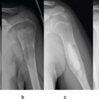 Figure 1: Initial unicameral bone cyst. Radiographic images of the left proximal humerus at initial presentation showing the unicameral bone cyst. Anteroposterior (AP) (a) and lateral (L) (b) radiographs demonstrating a radiolucent lesion in the left proximal humeral diaphysis with a pathologic fracture; AP (c) and L (d) post-treatment radiographs showing the lesion after curettage and calcium phosphate bone grafting, with radiopaque graft material filling the cavity.