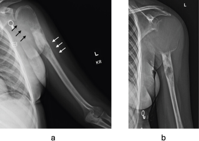 Figure 2: New aggressive lesion at 18 months. Radiographs obtained 18 months after initial treatment demonstrated malignant transformation. Anteroposterior (a) radiograph showing destructive cortical changes in the proximal medial humeral head and neck (black arrows) and ill-defined radiolucency in the distal aspect of the previously treated “unicameral bone cyst” (white arrows); (b) Lateral view demonstrating the expansile nature of the lesion with the associated soft-tissue component, located at the site of the previously treated unicameral bone cyst.