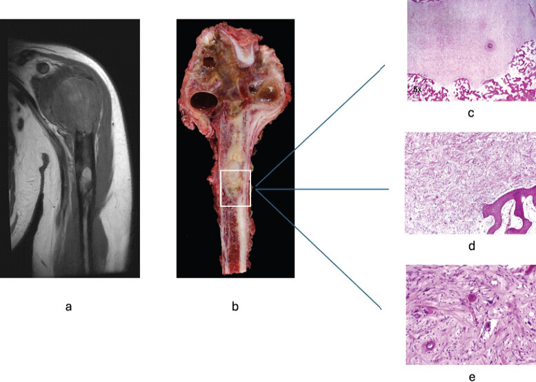 Figure 3: Magnetic resonance imaging (MRI), gross pathology, and histopathology. (a) Coronal T1-weighted post-contrast MRI showing a heterogeneous, expansile lesion in the proximal humeral metaphysis with multiple fluid-fluid levels and heterogeneous enhancement. (b) Gross specimen of the resected proximal humerus demonstrating the hemorrhagic and cystic nature of the tumor with multiple blood-filled cavities characteristic of telangiectatic osteosarcoma. The white box indicates the area of tissue for histologic interpretation; (c) Low-power photomicrograph ×5 (Hematoxylin and Eosin [H&E] stain) of the post-treatment resection specimen demonstrating a nodule of tumor surrounded by cancellous bone; (d) Medium-power photomicrograph ×10 (H&E stain) showing mostly collagen and a significant treatment effect; (e) High-power photomicrograph ×40 (H&E stain) demonstrating 100% treatment effect with mostly collagen and rare residual tumor cells.
