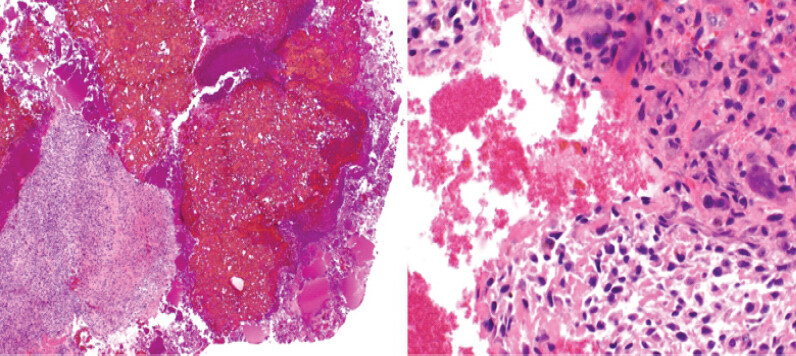 Figure 4: Pre-treatment biopsy histopathology. (a) Low-power photomicrograph (Hematoxylin and Eosin [H&E] stain) showing a hemorrhagic cystic mass with solid components of the cyst wall composed of tumor; (b) High-power photomicrograph (H&E stain) showing malignant cells associated with filigree neoplastic bone adjacent to a pool of blood, diagnostic of telangiectatic osteosarcoma.